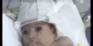 Правитель Аджмана оплатил операцию для ребенка с «двумя головами»