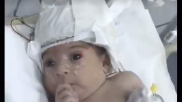 Правитель Аджмана оплатил операцию для ребенка с «двумя головами»